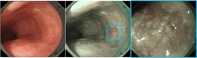 NBI併用拡大内視鏡検査