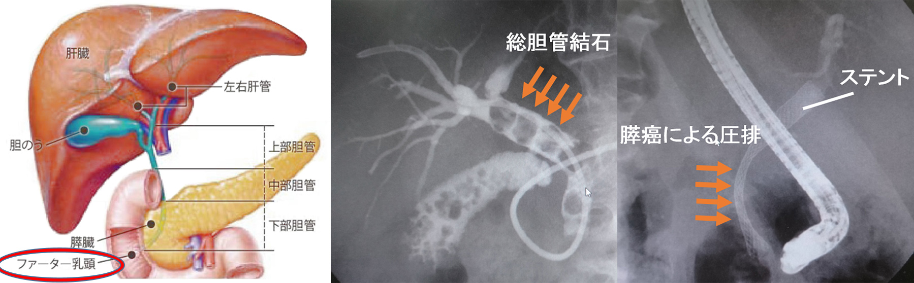 内視鏡的逆行性膵胆管造影(ERCP)とは