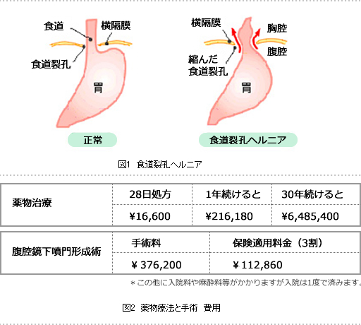 げっぷ 胃腸 炎 重大な胃腸疾患は「げっぷ」で判明! 少しでも自覚や不快感があれば受診を｜健康・医療情報でＱＯＬを高める～ヘルスプレス/HEALTH